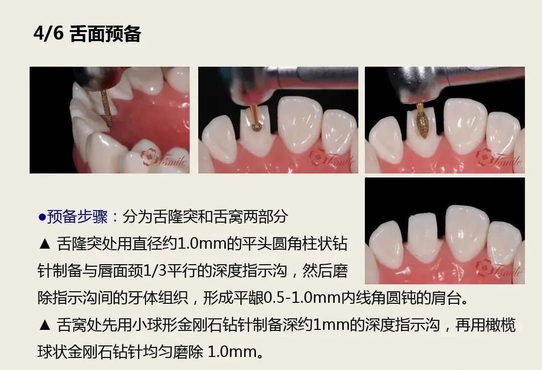 前牙全瓷冠的牙体预备