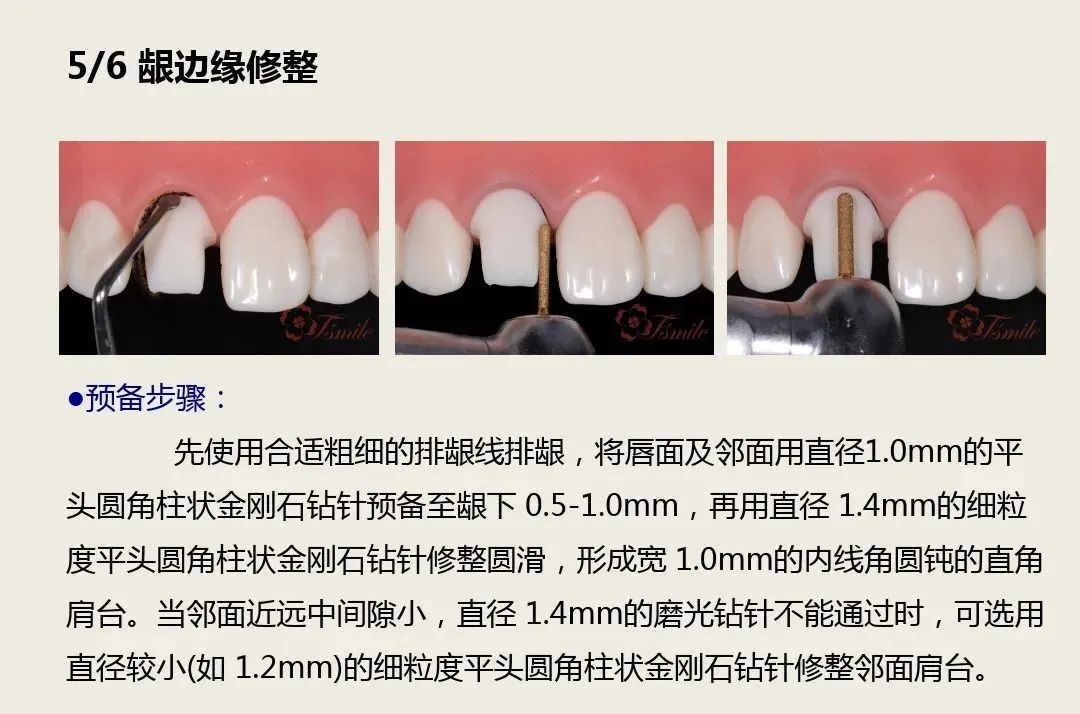 前牙全瓷冠的牙体预备