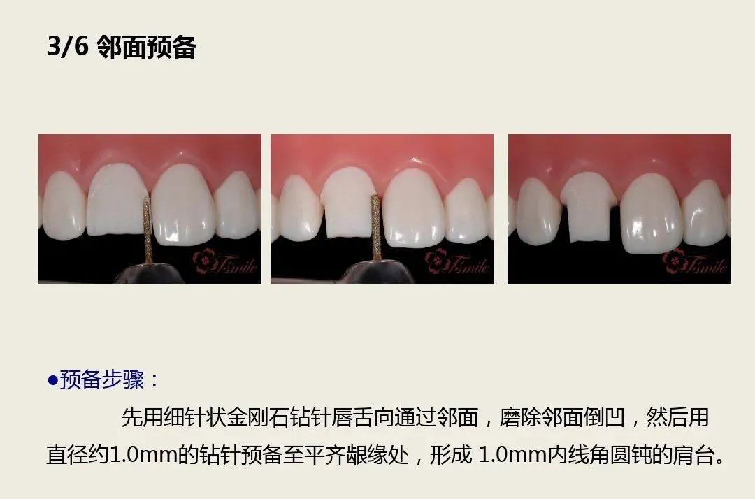 前牙全瓷冠的牙体预备