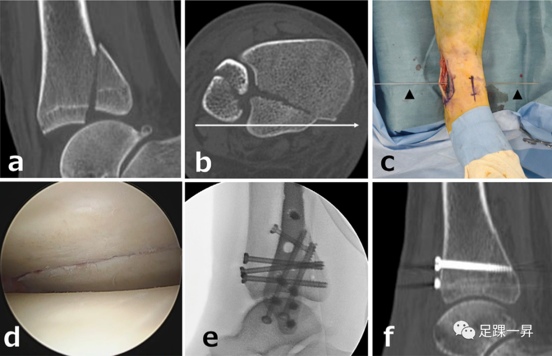 关节镜下车把（Handlebar）技术治疗后踝骨折
