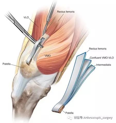 【手术技术】自体股四头肌重建前交叉韧带