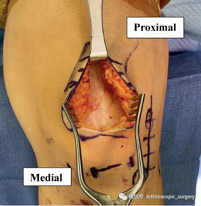 【手术技术】自体股四头肌重建前交叉韧带
