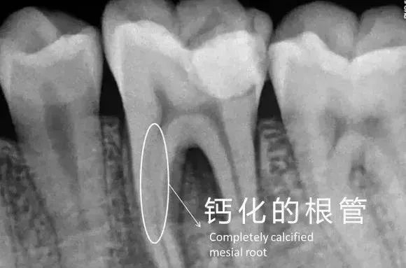 钙化根管的处理方法