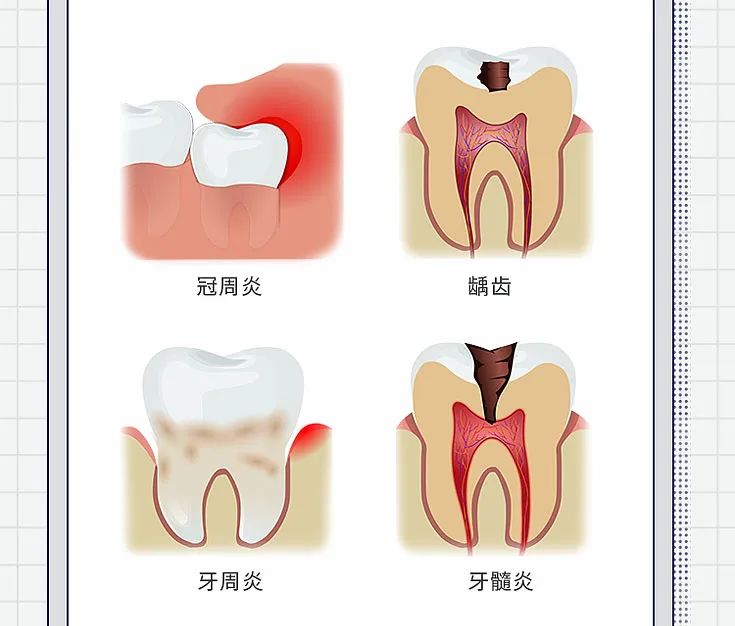 智齿拔or不拔？