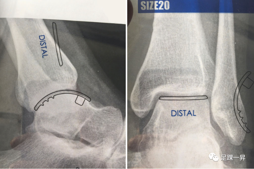 【手术技巧】半踝置换治疗严重距骨骨软骨损伤