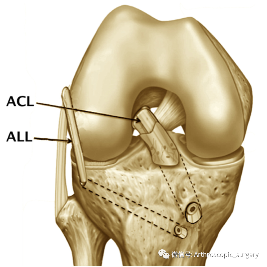 【手术理念】自体肌腱重建前交叉韧带太细该怎么办？