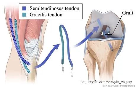 【手术理念】自体肌腱重建前交叉韧带太细该怎么办？