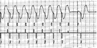 起搏器功能异常的心电图表现