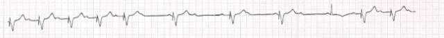 起搏器功能异常的心电图表现