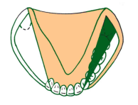 全口义齿无牙颌解剖标志和功能分区详解