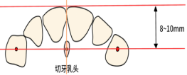 全口义齿无牙颌解剖标志和功能分区详解