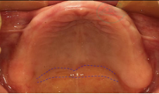 全口义齿无牙颌解剖标志和功能分区详解