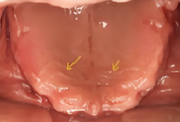 全口义齿无牙颌解剖标志和功能分区详解