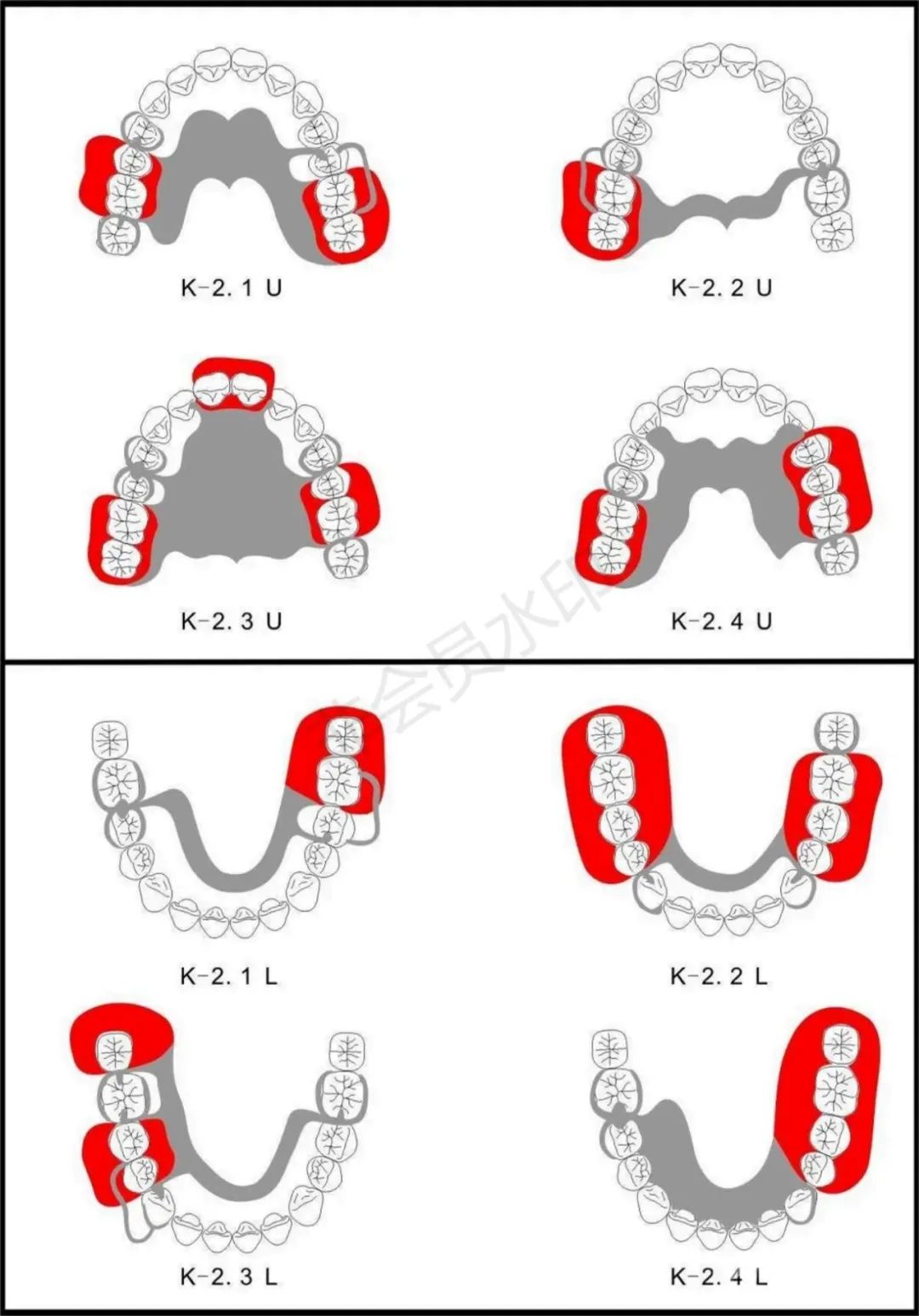 收藏！活动义齿设计图谱