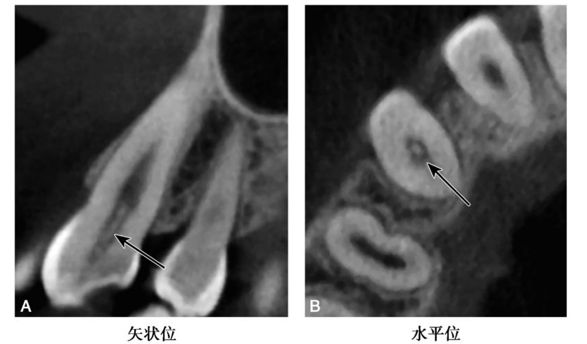 牙髓钙化的CBCT表现