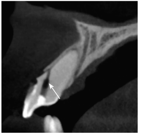 牙髓钙化的CBCT表现