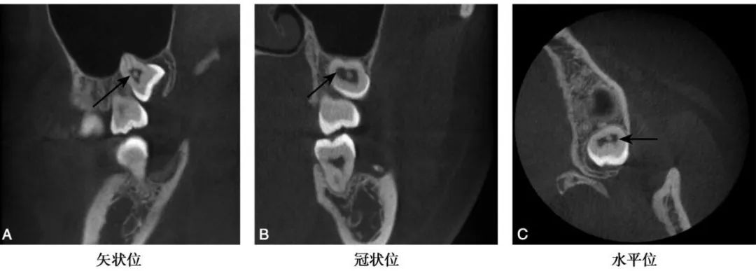 牙髓钙化的CBCT表现