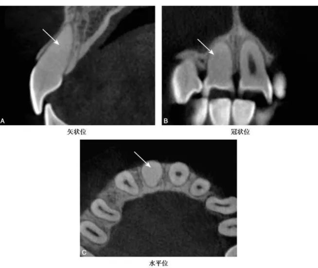 牙髓钙化的CBCT表现