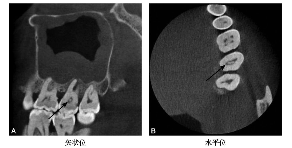牙髓钙化的CBCT表现