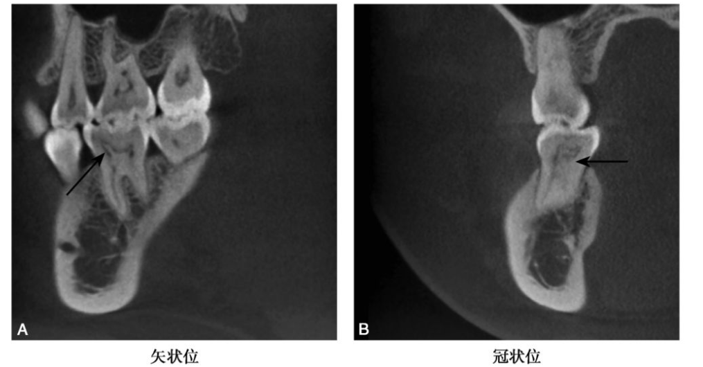 牙髓钙化的CBCT表现