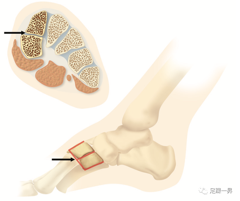 【足踝病例】二分内侧楔状骨（Bipartite