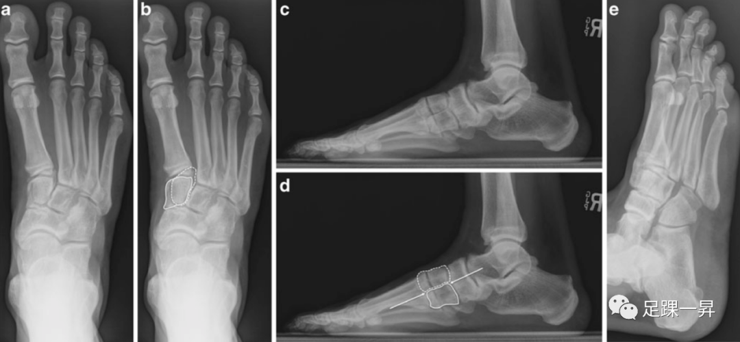 【足踝病例】二分内侧楔状骨（Bipartite