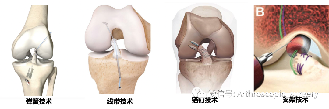 【手术理念】沉寂了半个世纪的前交叉韧带修补技术，能否逆风翻盘？