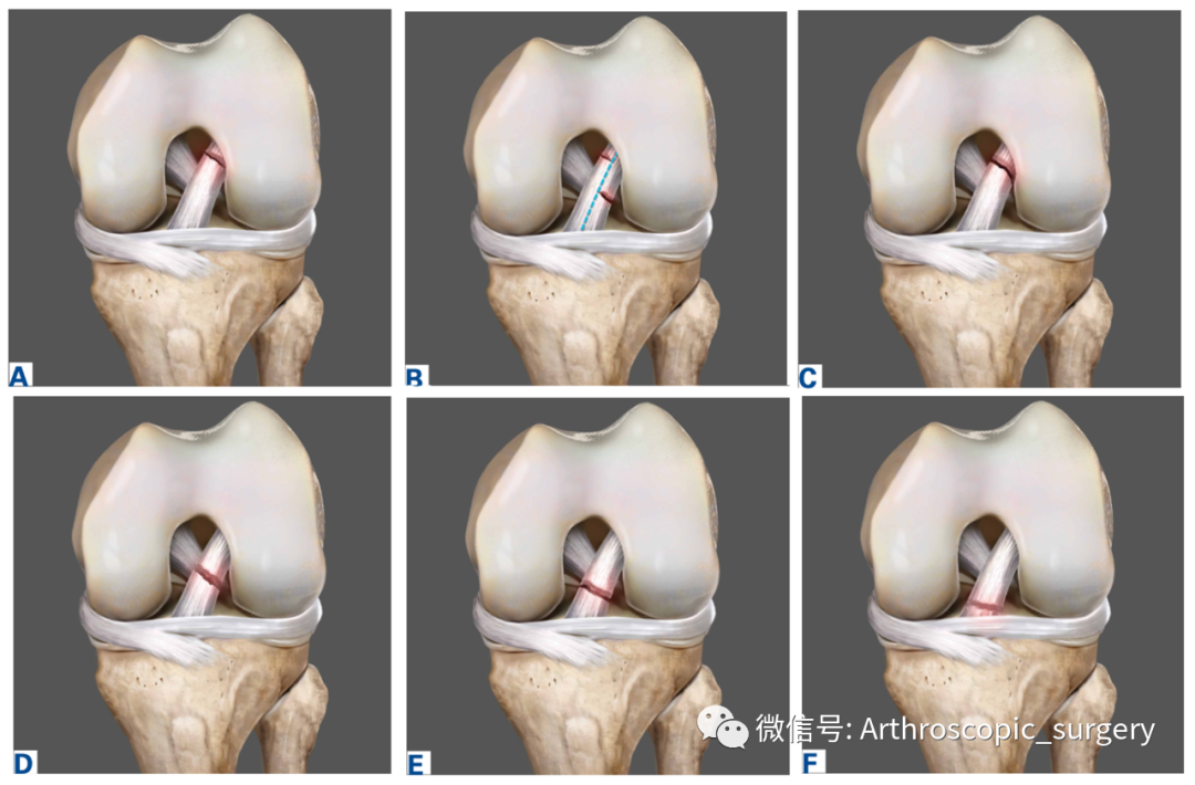 【手术理念】沉寂了半个世纪的前交叉韧带修补技术，能否逆风翻盘？