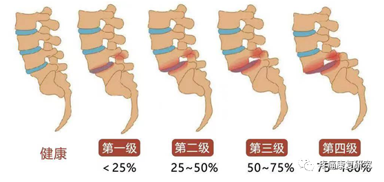 腰椎滑脱的分型、病因、诊断和治疗及锻炼