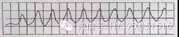 严重心律失常的急救处理，你做对了多少？