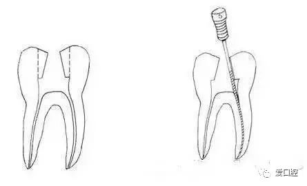良心总结：不同牙位的开髓改良打开方式