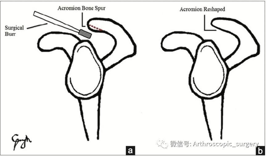 【手术理念】到底要不要做在肩袖修补时进行肩峰成形？