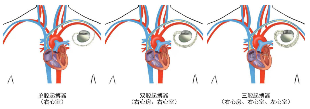 关于心脏起搏器，你了解多少？