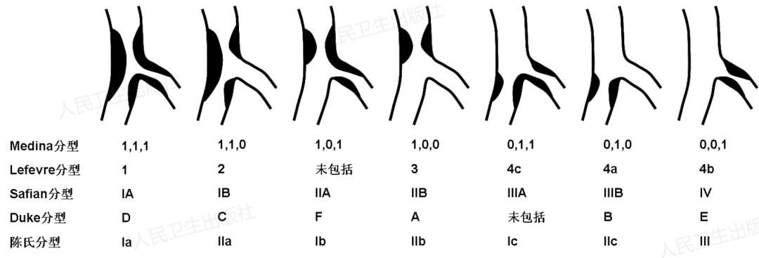 冠脉分叉病变的介入治疗策略