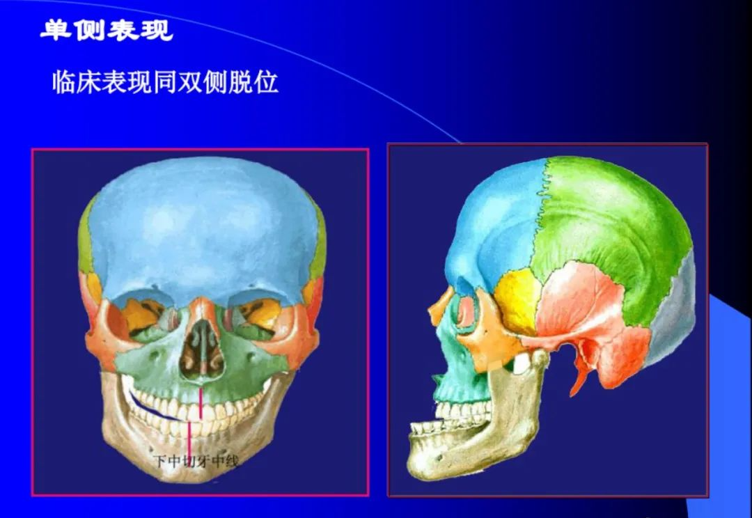 口腔颌面外科学：颞下颌关节脱位