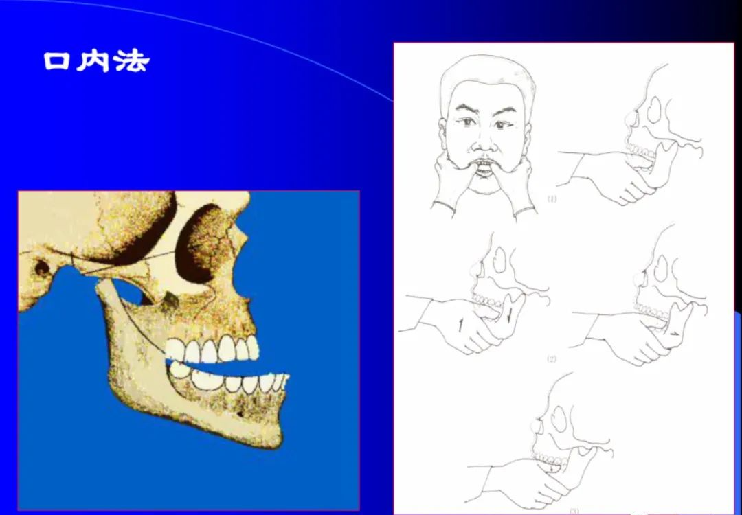 口腔颌面外科学：颞下颌关节脱位