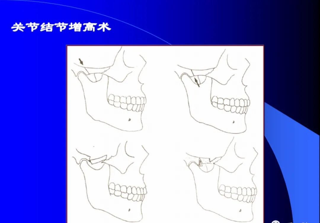 口腔颌面外科学：颞下颌关节脱位