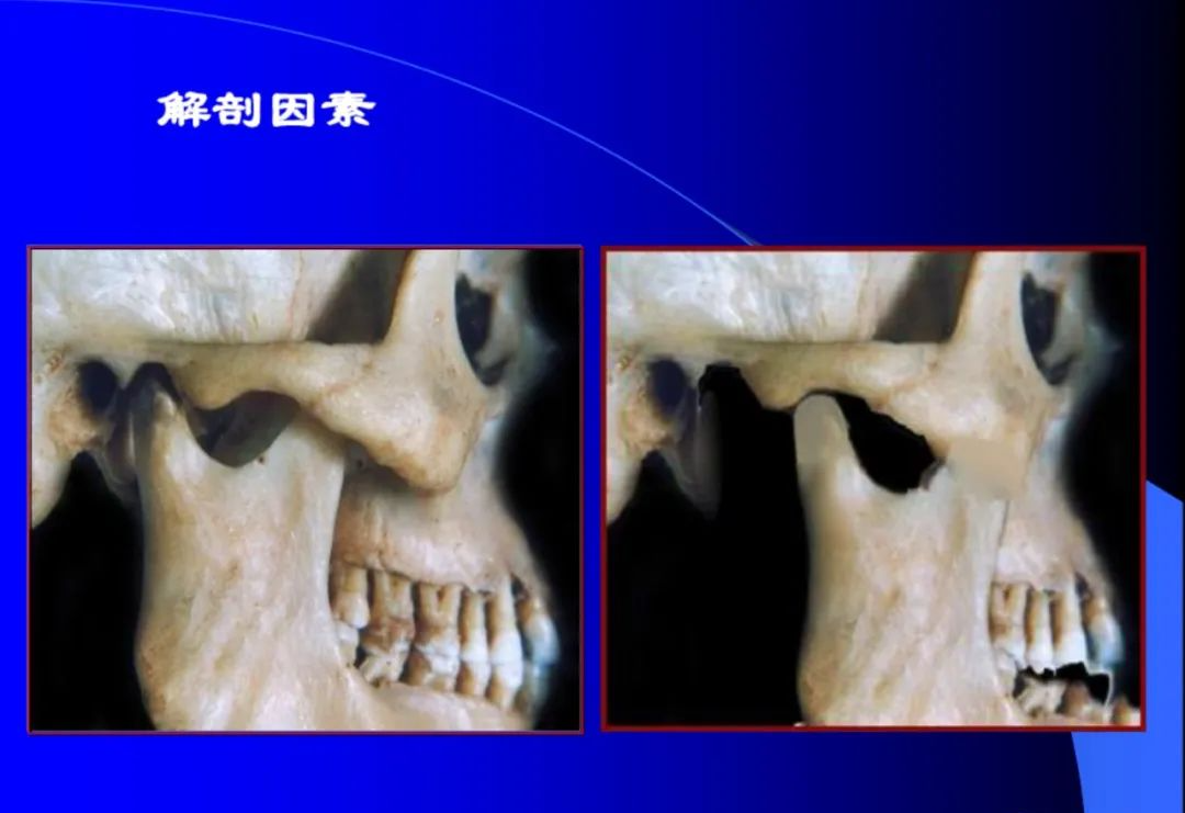 口腔颌面外科学：颞下颌关节脱位