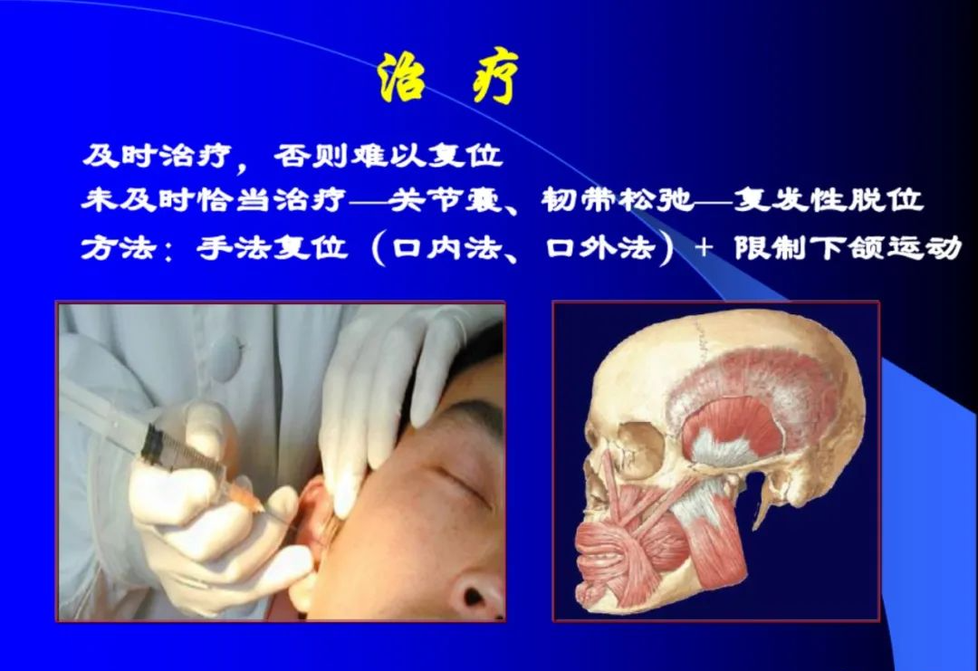 口腔颌面外科学：颞下颌关节脱位