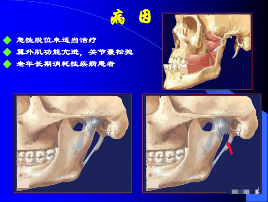 口腔颌面外科学：颞下颌关节脱位