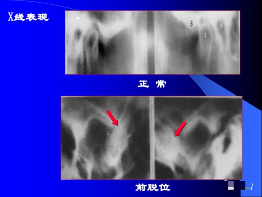 口腔颌面外科学：颞下颌关节脱位