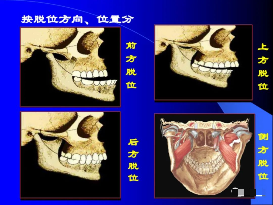 口腔颌面外科学：颞下颌关节脱位