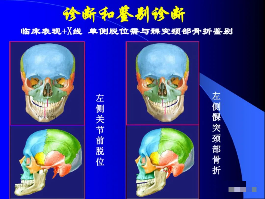 口腔颌面外科学：颞下颌关节脱位