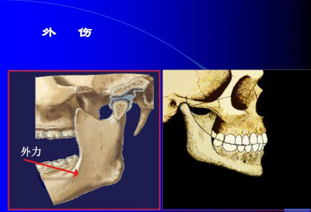 口腔颌面外科学：颞下颌关节脱位