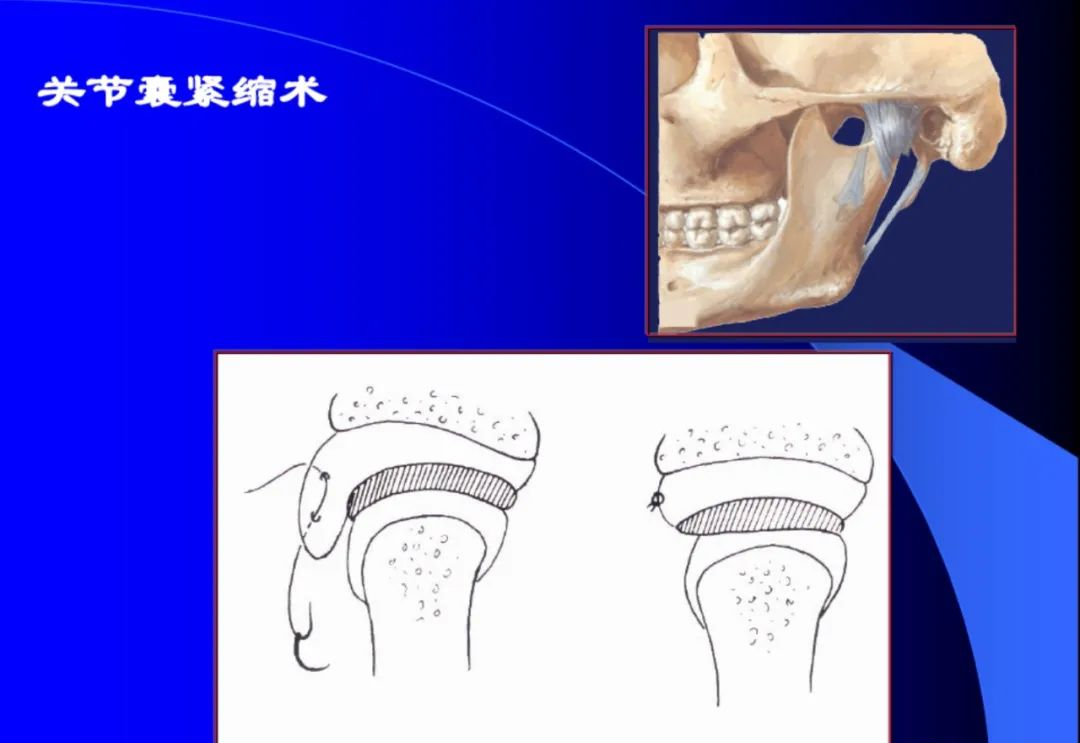 口腔颌面外科学：颞下颌关节脱位