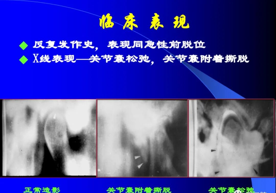 口腔颌面外科学：颞下颌关节脱位