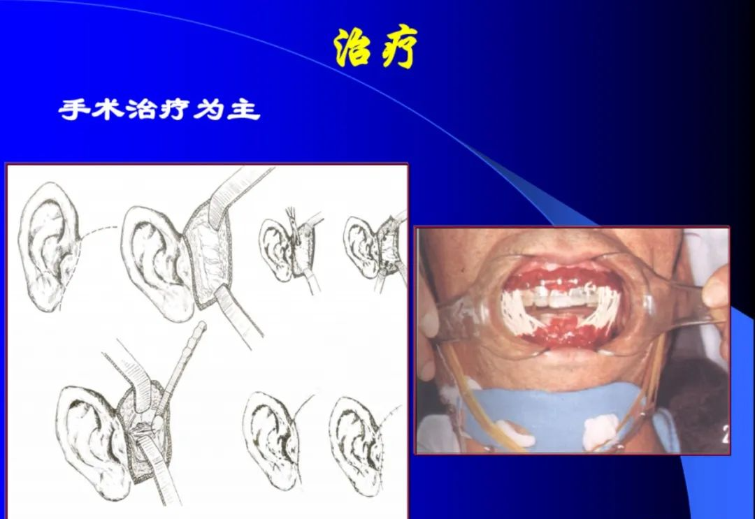 口腔颌面外科学：颞下颌关节脱位