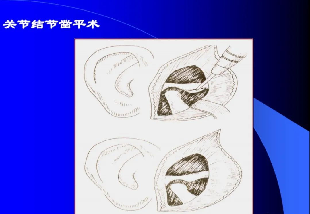 口腔颌面外科学：颞下颌关节脱位