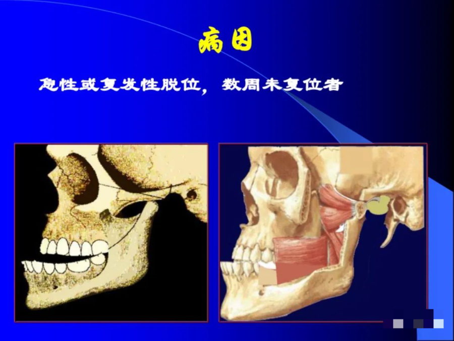 口腔颌面外科学：颞下颌关节脱位