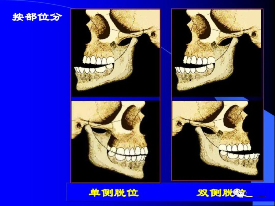 口腔颌面外科学：颞下颌关节脱位